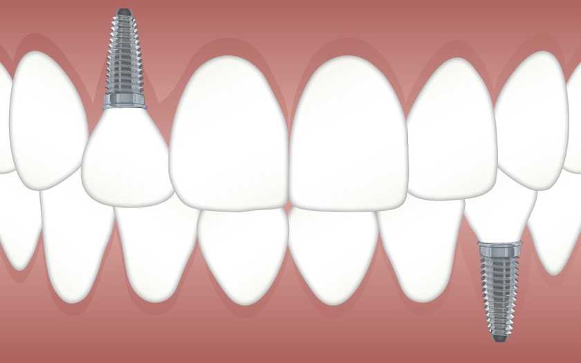 O que são implantes dentários