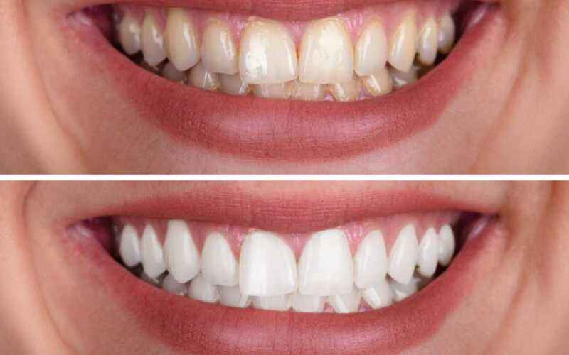 Como fazer clareador dental caseiro