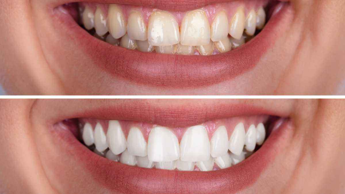 Como fazer clareador dental caseiro