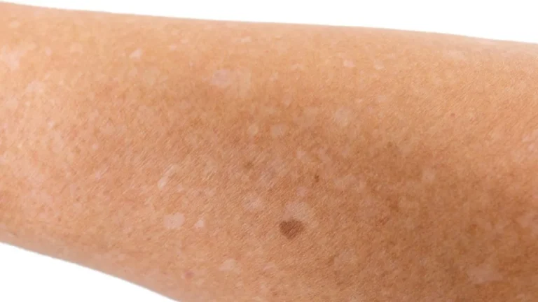 Como prevenir manchas brancas na pele