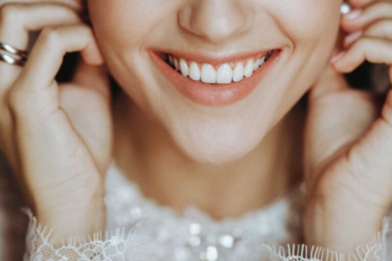 Clareamento Dental para Casamento: Como Preparar seu Sorriso